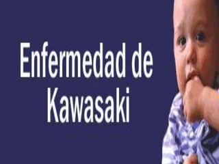 Enfermedad de Kawasaki
Alumnas:
Guzmán García diana Celina
Castro Valenzuela Citlali
Arvizu Villegas Karla Valeria

 