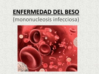 ENFERMEDAD DEL BESO
(mononucleosis infecciosa)
 