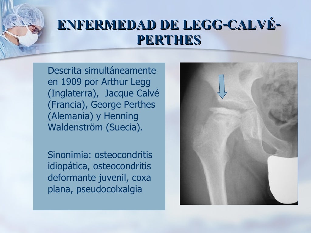 Enfermedad De Legg Calvé Perthes Enfermedad De Legg Calvé Perthes