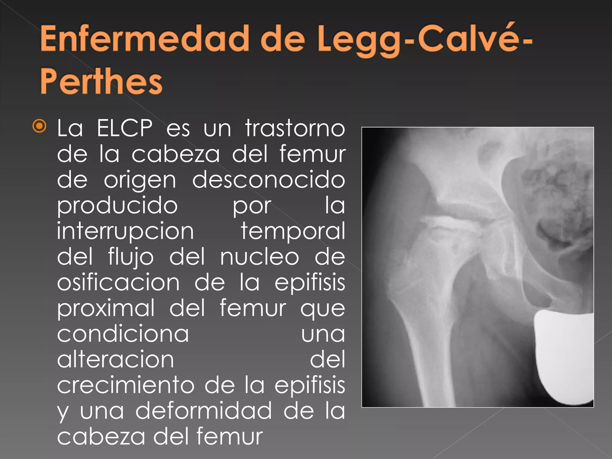 Enfermedad de legg calvé-perthes | PPT
