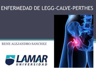 ENFERMEDAD DE LEGG-CALVE-PERTHES 
RENE ALEJANDRO SANCHEZ 
 