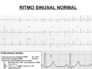 Enfermedad del nodo sinusal enfermo (snse) | PPT