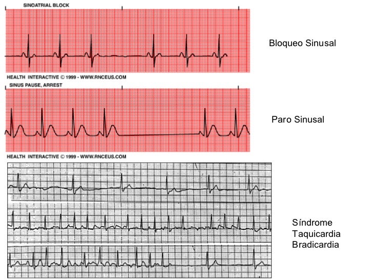 Enfermedad del nodo sinusal enfermo (snse)