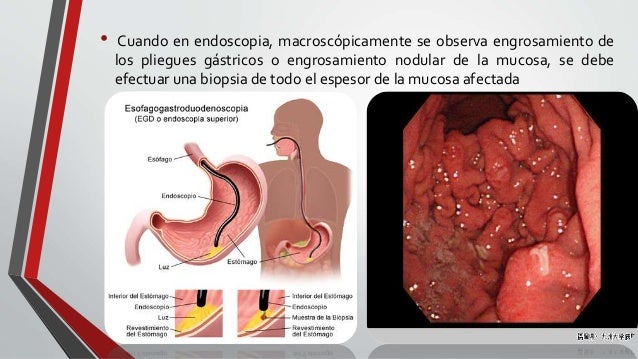 Progression of meniere's disease image