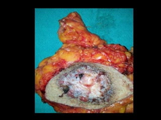 Enfermedad de paget - Dr. Jesus Torres Vasquez 