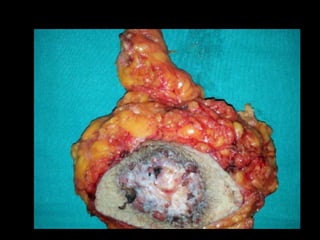 Enfermedad de paget - Dr. Jesus Torres Vasquez 