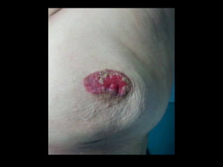 Enfermedad de paget - Dr. Jesus Torres Vasquez 