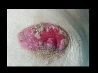 Enfermedad de paget - Dr. Jesus Torres Vasquez 