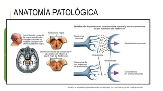 ANATOMÍA PATOLÓGICA
Despigmentación de la sustancia
negra mesencefálica
Perdida progresiva de neuronas
70%(neuromelanina)
Disminución del mas 80% de
dopamina del sistema
nigroestrial
Sx. Rígido acinético
Gliosis reactiva y presencia de
cuerpo de Lewy
Núcleos dopaminergicos y
núcleo basal de Meynert
Lesión en la
sustancia negra
TRATADO DE NEUROPSICOGERIATRIA, PEDRO GIL GREGORIO, 2011,SOCIEDAD DE GETRIA Y GERONTOLOGÍA
 