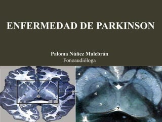 ENFERMEDAD DE PARKINSON
Paloma Núñez Malebrán
Fonoaudióloga

 