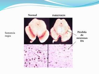 Sustancia
negra
Pérdida
de
neuronas
DA
Normal PARKINSON
 