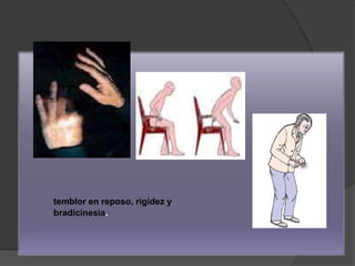 temblor en reposo, rigidez y
bradicinesia.
 