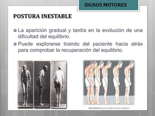  La aparición gradual y tardía en la evolución de una
dificultad del equilibrio.
 Puede explorarse tirando del paciente hacia atrás
para comprobar la recuperación del equilibrio.
POSTURA INESTABLE
SIGNOS MOTORES
 