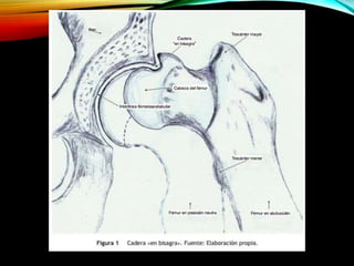 Enfermedad de perthes