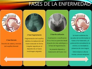 1 Fase Necrosis
Sinovitis de cadera y necrosis
de la epífisis femoral
2 Fase Fragmentación
Fragmentación de la epífisis,
debida a la reabsorción del
hueso avascular en forma
irregular seguida por el
deposito de un hueso
vivo(imagen atigrada).
3 Fase Re osificación
Cicatrización o reosificacion.
En su inicio es parecida desde
el punto de vista radiológico a
la fase de fragmentación.
Se presenta deposito y
maduración del hueso vivo
4 Fase final
Se hacen evidentes las
secuelas de la enfermedad, el
hueso a ha madurado y el
potencial de remodelación es
mínimo, es inevitable la
presencia de coxa magna.
Deformidad en silla de
montar, artrosis temprana
FASES DE LA ENFERMEDAD
 