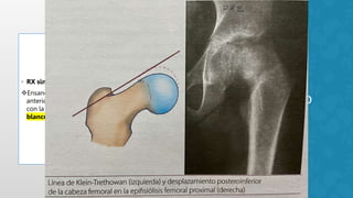 Lowenstein Rx Enfermedad de perthes.pptx