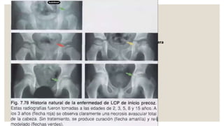 Lowenstein Rx Enfermedad de perthes.pptx