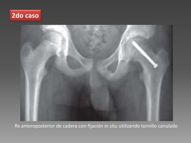 Enfermedad De Perthes Y Epifisiolistesis Femoral Proximal Casos Cl nicos enfermedad-de-perthes-y-epifisiolistesis-femoral-proximal-casos-cl-nicos