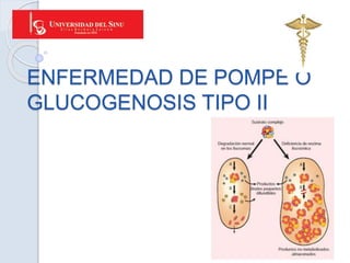 ENFERMEDAD DE POMPE O
GLUCOGENOSIS TIPO II
 