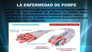LA ENFERMEDAD DE POMPE
La enfermedad de Pompe o glucogenosis tipo II es un trastorno metabólico
causado por una acumulación de glucógeno en múltiples tejidos,
principalmente el músculo, provocando insuficiencia cardiaca, motora y
respiratoria progresivas. Es debida a la deficiencia de la enzima lisosomal
α-glucosidasa ácida o maltasa ácida.
 