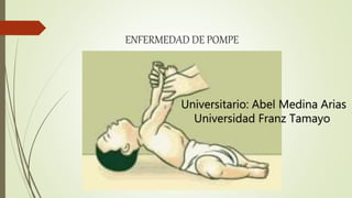 ENFERMEDAD DE POMPE
Universitario: Abel Medina Arias
Universidad Franz Tamayo
 