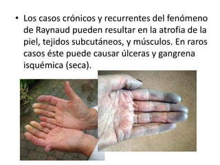 • Los casos crónicos y recurrentes del fenómeno
de Raynaud pueden resultar en la atrofia de la
piel, tejidos subcutáneos, y músculos. En raros
casos éste puede causar úlceras y gangrena
isquémica (seca).
 