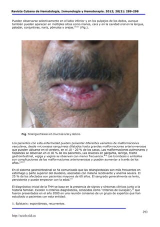 Revista Cubana de Hematología, Inmunología y Hemoterapia. 2012; 28(3): 289-298 
Pueden observarse selectivamente en el labio inferior y en los pulpejos de los dedos, aunque 
también pueden aparecer en múltiples sitios como manos, cara y en la cavidad oral en la lengua, 
paladar, conjuntivas, nariz, pómulos y orejas.10,11 (Fig.). 
Los pacientes con esta enfermedad pueden presentar diferentes variantes de malformaciones 
vasculares, desde microvasos sanguíneos dilatados hasta grandes malformaciones arterio-venosas 
que pueden ubicarse en el cerebro, en el 10 - 20 % de los casos. Las malformaciones pulmonares y 
hepáticas se observan en el 30 % de los pacientes. Las lesiones en garganta, laringe, tracto 
gastrointestinal, vejiga y vagina se observan con menor frecuencia.4-6 Las trombosis o embolias 
son complicaciones de las malformaciones arteriovenosas y pueden aumentar a través de los 
años.12,13 
http://scielo.sld.cu 
293 
En el sistema gastrointestinal se ha comunicado que las telangiectasias son más frecuentes en 
estómago y parte superior del duodeno, asociadas con melena recidivante y anemia severa. El 
25 % de los afectados son pacientes mayores de 60 años. El sangrado generalmente es lento, 
persistente y puede empeorar con la edad.14 
El diagnóstico inicial de la THH se basa en la presencia de signos y síntomas clínicos junto a la 
historia familiar. Existen 4 criterios diagnósticos, conocidos como "criterios de Curaçao",15 que 
fueron presentados en el año 2000 en una reunión consenso de un grupo de expertos que han 
estudiado a pacientes con esta entidad: 
1. Epístaxis: espontáneas, recurrentes. 
 