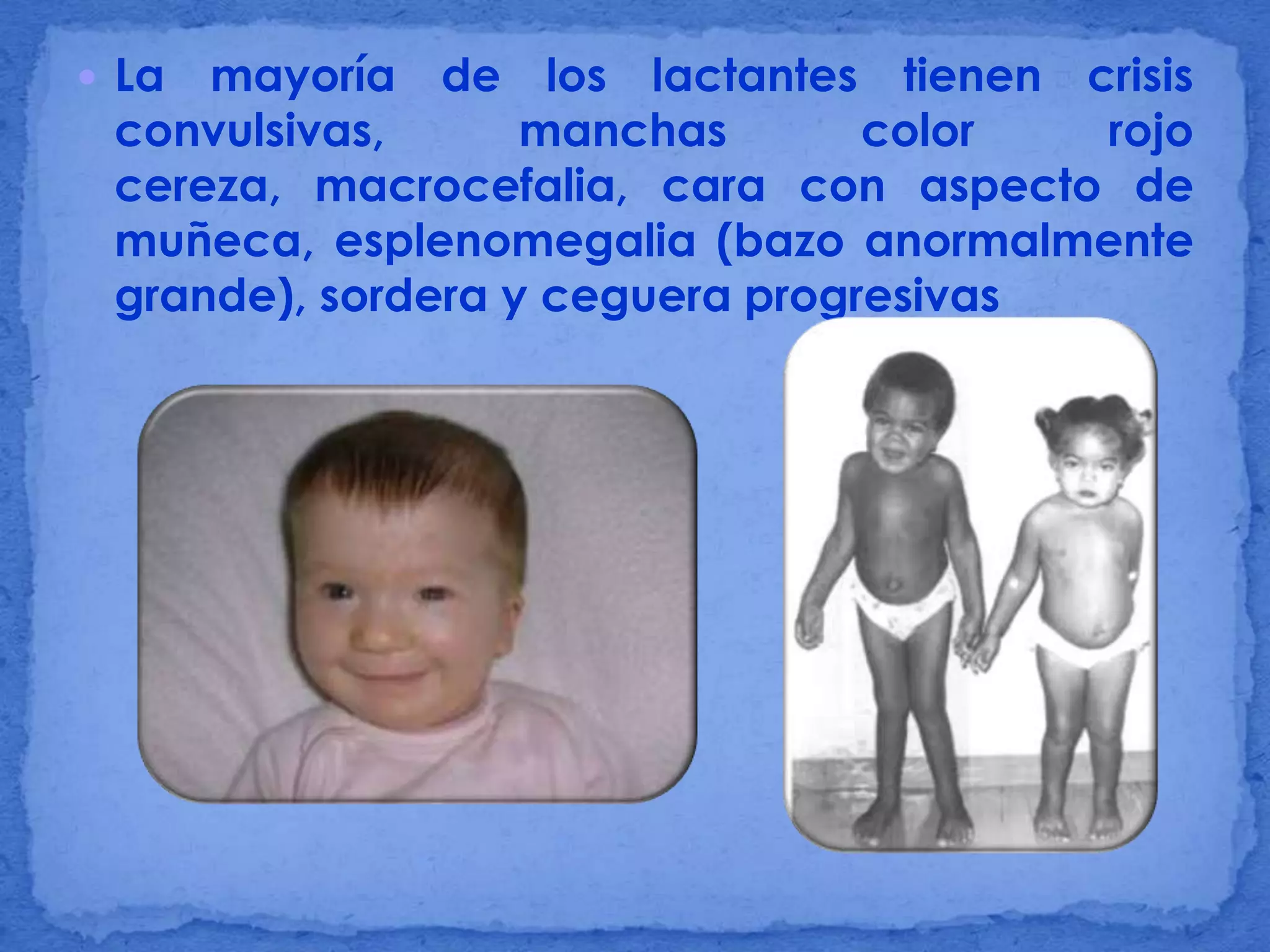 Enfermedad de sandhoff (1) | PPT