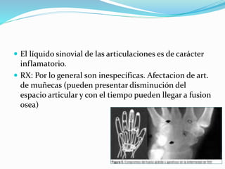  El líquido sinovial de las articulaciones es de carácter
inflamatorio.
 RX: Por lo general son inespecíficas. Afectacion de art.
de muñecas (pueden presentar disminución del
espacio articular y con el tiempo pueden llegar a fusion
osea)
 