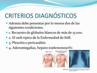 CRITERIOS DIAGNÓSTICOS
 Además debe presentar por lo menos dos de las
siguientes condiciones.
 1. Recuento de glóbulos blancos de más de 15.000.
 2. El rash típico de la Enfermedad de Still.
 3. Pleuritis o pericarditis.
 4. Adenomegalias, hepato-esplenomegalia.
 