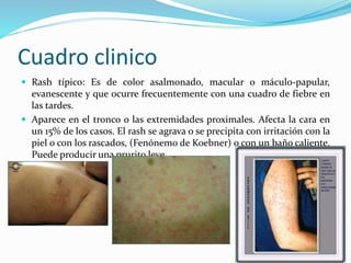 Cuadro clinico
 Rash típico: Es de color asalmonado, macular o máculo-papular,
evanescente y que ocurre frecuentemente con una cuadro de fiebre en
las tardes.
 Aparece en el tronco o las extremidades proximales. Afecta la cara en
un 15% de los casos. El rash se agrava o se precipita con irritación con la
piel o con los rascados, (Fenónemo de Koebner) o con un baño caliente.
Puede producir una prurito leve.
 