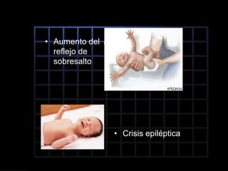 • Aumento del
reflejo de
sobresalto
• Crisis epiléptica
 
