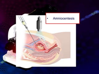 • Amniocentesis
 