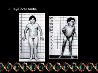 • Tay-Sachs tardía
 