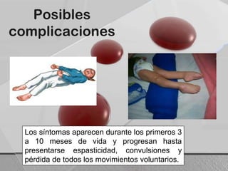 Posibles
complicaciones
Los síntomas aparecen durante los primeros 3
a 10 meses de vida y progresan hasta
presentarse espasticidad, convulsiones y
pérdida de todos los movimientos voluntarios.
 