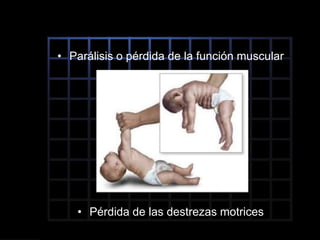 • Parálisis o pérdida de la función muscular
• Pérdida de las destrezas motrices
 