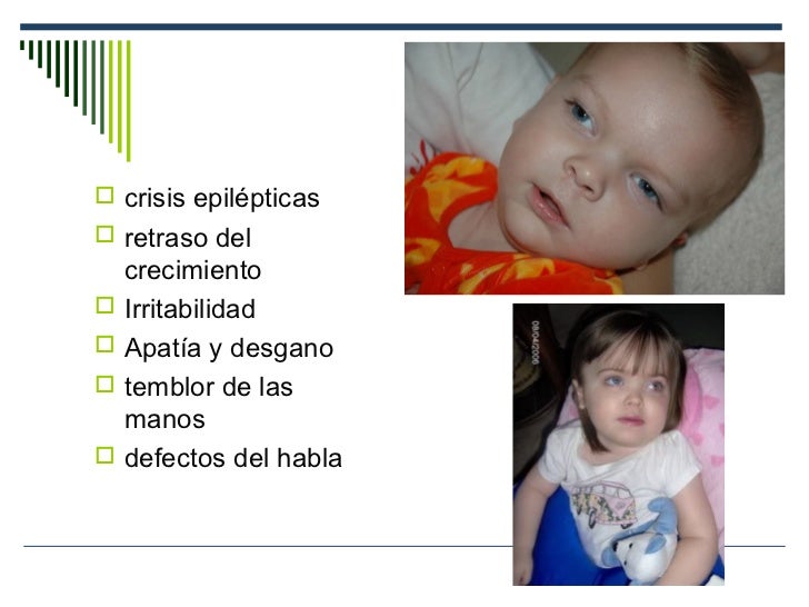 Enfermedad de Tay Sachs