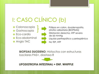 I: CASO CLÍNICO (b)
 Colonoscopia
 Gastroscopia
 Eco-cardio
 Eco-abdominal
 Angio TAC
Dilatación derecha, HTP severa
de 66 mmHg
Pólipos en colon, duodenopatía,
atrofia vellositaria (BIOPSIAS)
Líquido perihepático y periesplénico
No TEP, HTP
BIOPSIAS DUODENO: Histiocitos con estructuras
bacilares PAS+, diastasa R
LIPODISTROFIA INTESTINAL = ENF. WHIPPLE
 