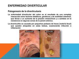 ENFERMEDAD DIVERTICULAR
Patogenesis de la diverticulosis
La enfermedad diverticular del colon es el resultado de una compleja
interacción entre factores dietéticos, genéticos y de motilidad intestinal,
que llevan a un aumento de la presión intraluminal y a cambios en la
resistencia en algunas zonas de la pared colónica.
La diverticulitis es causada por pequeños pedazos de heces (materia fecal)
que quedan atrapados en estas bolsas, ocasionando infección o
inflamación
 