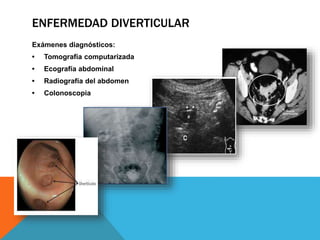ENFERMEDAD DIVERTICULAR
Exámenes diagnósticos:
• Tomografía computarizada
• Ecografía abdominal
• Radiografía del abdomen
• Colonoscopia
 