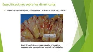 Especificaciones sobre los divertículos
 Suelen ser asintomáticos. En ocasiones, presentan dolor recurrente.
Diverticulosis: imagen que muestra el intestino
grueso (colon sigmoide) con múltiples divertículos
 
