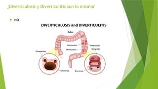 ¿Diverticulosis y Diverticulitis son lo mismo?
 NO
 