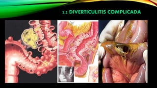 2.2 DIVERTICULITIS COMPLICADA
 