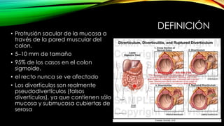 DEFINICIÓN
• Protrusión sacular de la mucosa a
través de la pared muscular del
colon.
• 5–10 mm de tamaño
• 95% de los casos en el colon
sigmoide.
• el recto nunca se ve afectado
• Los divertículos son realmente
pseudodivertículos (falsos
divertículos), ya que contienen sólo
mucosa y submucosa cubiertas de
serosa
 
