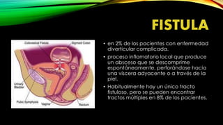 FISTULA
• en 2% de los pacientes con enfermedad
diverticular complicada.
• proceso inflamatorio local que produce
un absceso que se descomprime
espontáneamente, perforándose hacia
una víscera adyacente o a través de la
piel.
• Habitualmente hay un único tracto
fistuloso, pero se pueden encontrar
tractos múltiples en 8% de los pacientes.
 