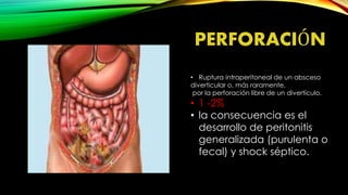 PERFORACIÓN
• Ruptura intraperitoneal de un absceso
diverticular o, más raramente,
por la perforación libre de un divertículo.
• 1 -2%
• la consecuencia es el
desarrollo de peritonitis
generalizada (purulenta o
fecal) y shock séptico.
 