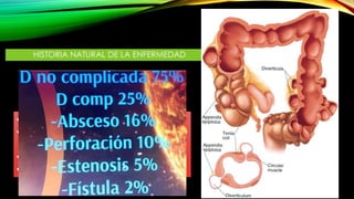 HISTORIA NATURAL DE LA ENFERMEDAD
• DIVERTICULOSIS CÓLICA
• ENFERMEDAD DIVERTICULAR NO
COMPLICADA 75%
• DIVERTICULITIS 25%  75% leve
• HEMORRAGIA DIVERTICULAR.
 