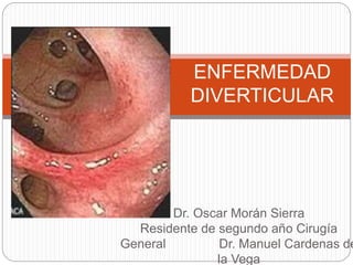 Dr. Oscar Morán Sierra
Residente de segundo año Cirugía
General Dr. Manuel Cardenas de
la Vega
ENFERMEDAD
DIVERTICULAR
 