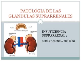 PATOLOGIA DE LAS GLANDULAS SUPRARRENALES INSUFICIENCIA SUPRARRENAL : AGUDA Y CRONICA(ADDISON) 