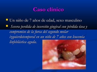Caso clínicoCaso clínico
 Un niño de 7 años de edad, sexo masculinoUn niño de 7 años de edad, sexo masculino
 Severa perdida de inserción gingival con pérdida ósea ySevera perdida de inserción gingival con pérdida ósea y
compromiso de la furca del segundo molarcompromiso de la furca del segundo molar
izquierdotemporal en un niño de 7 años con leucemiaizquierdotemporal en un niño de 7 años con leucemia
linfoblástica aguda.linfoblástica aguda.
 